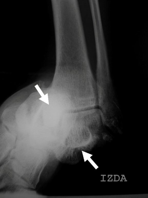 Figure 2: Lateral radiograph of the ankle showing medial displacement of the calcaneus and the tarsal bones while the talus remains in its position (arrow).